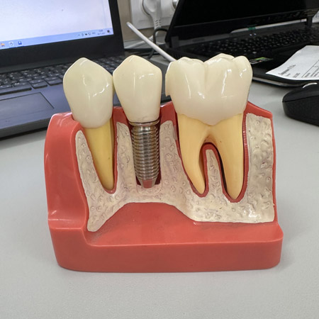 Зубной имплантат состоит из нескольких частей: самого имплантата, винта, абатмента и коронки