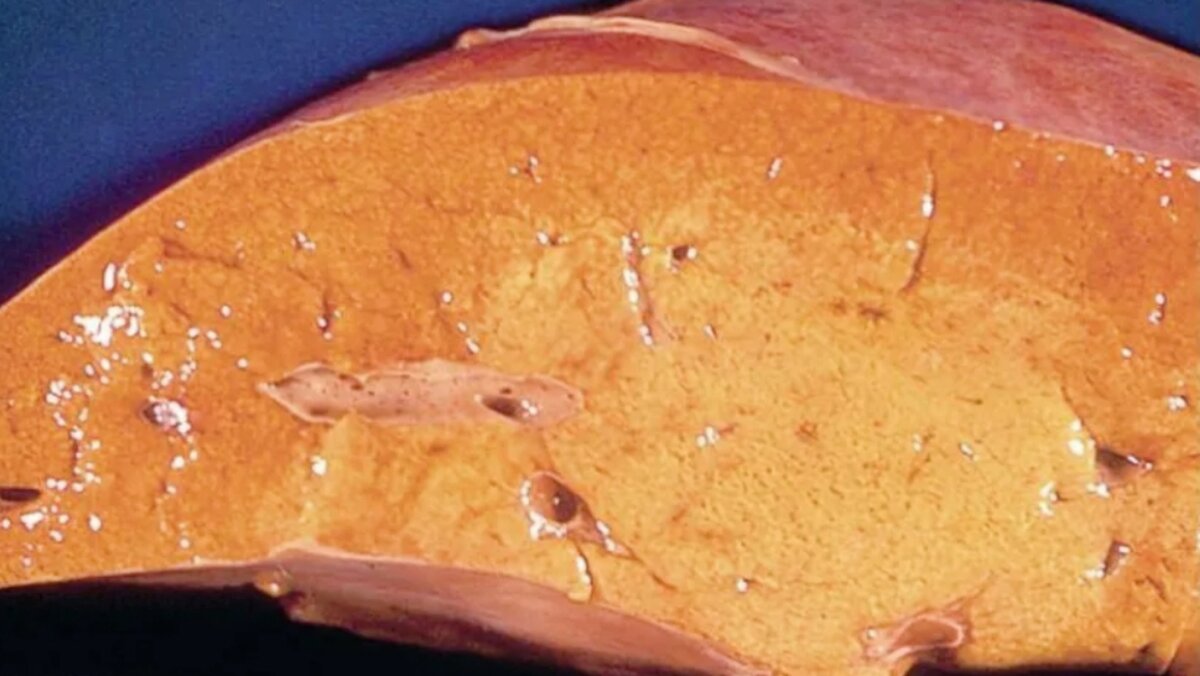 Печень при жировом гепатозе 