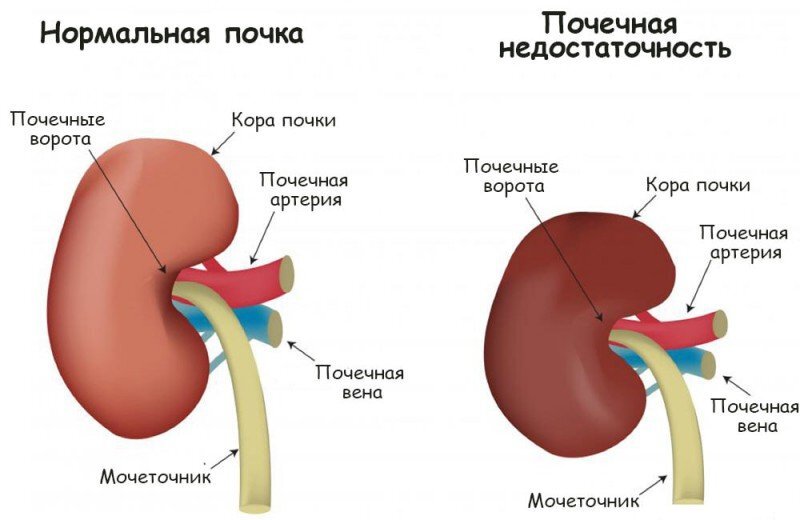 В ходе ХПН в почечной ткани постепенно погибают клетки и скапливаются азотистые вещества, которые ведут к общей интоксикации. Чаще всего состояние становится следствием хронических почечных заболеваний, а также перенесенных кишечных инфекций, пневмонии и так далее. Развивается ХПН и в результате процессов старения в организме, нарушения обмена веществ.