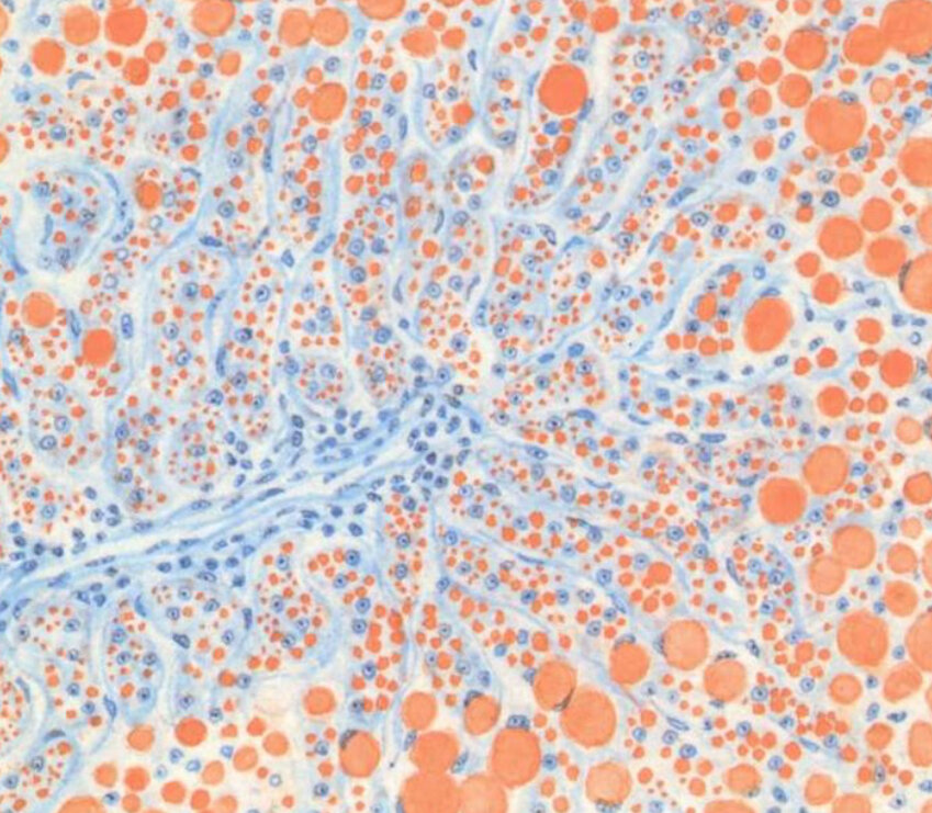 Жировая дистрофия печени под микроскопом. Фото из интернета.