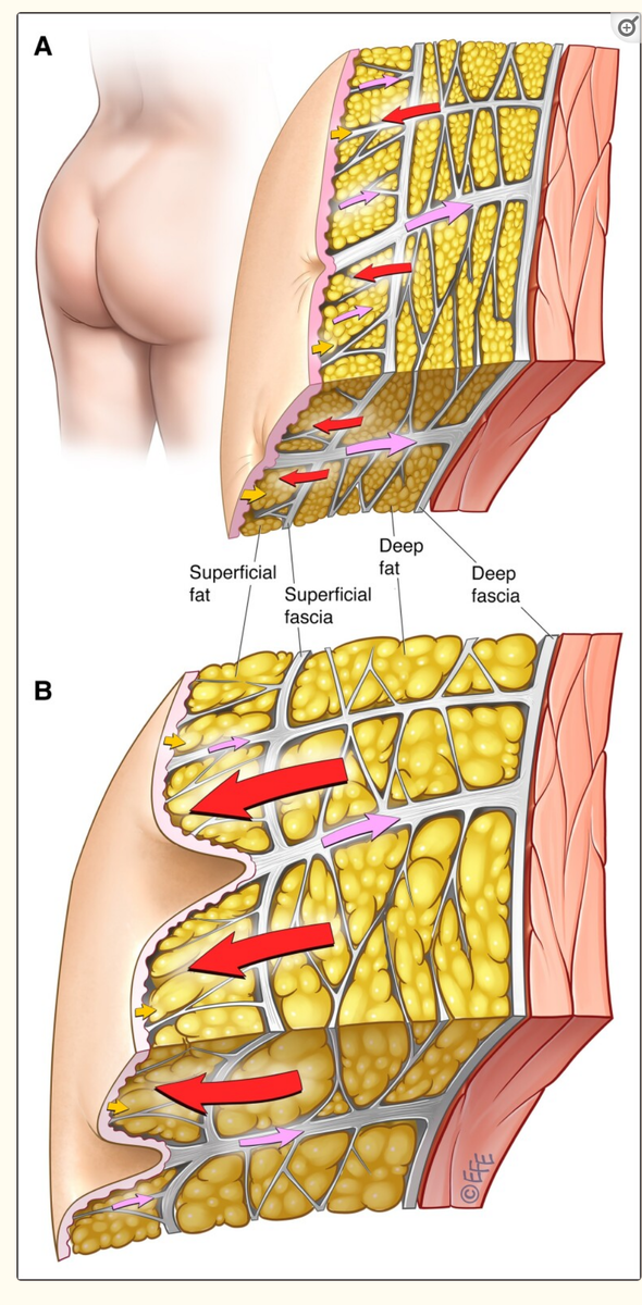 Подкожная ягодичная структура у женщин.Структура и расположение кожи и подкожной клетчатки у лиц с (А) низким или нормальным ИМТ или (Б) высоким ИМТ. Стрелки демонстрируют взаимодействие биомеханических сил (красные стрелки: внешняя сила жировых долек; розовые стрелки: внутренняя сила связывания септальной сети, с многочисленными короткими и тонкими перегородками [маленькие розовые стрелки] и менее длинными и толстыми перегородками, которые обладают большей стабильностью [большие розовые стрелки]; желтые стрелки: внутренняя удерживающая сила дермы).