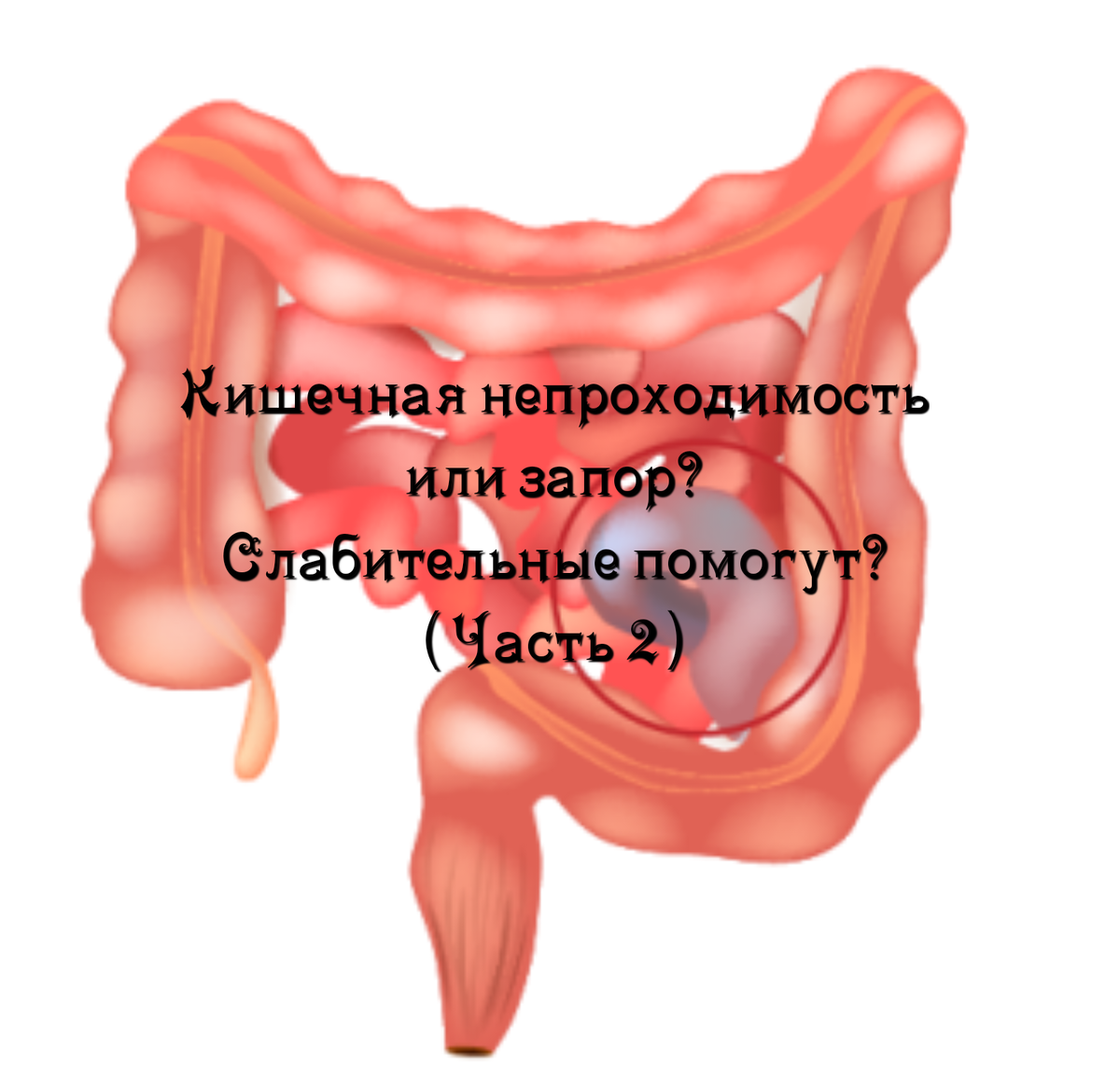 Кишечная непроходимость или запор? Слабительные помогут? (Часть 2) | Просто  о сложном (советы хирурга, травматолога-ортопеда) | Дзен