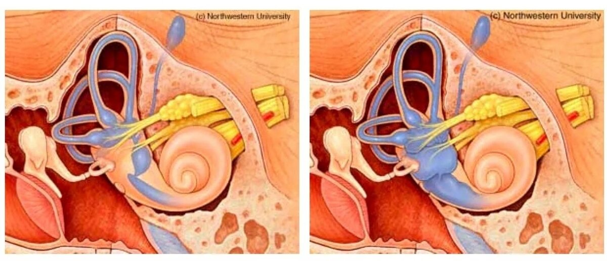 Слева- здоровое ухо, справа- повышение количества эндолимфы вызывает расширение перепончатого лабиринта. Гидропс.