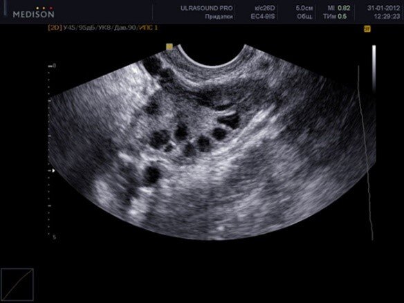 *здоровый яичник