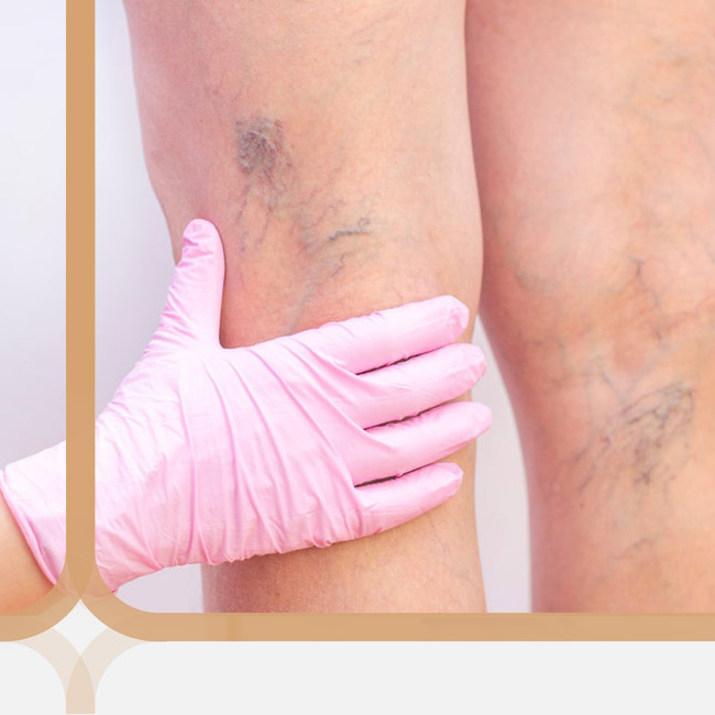 Сосудистые звездочки на ногах