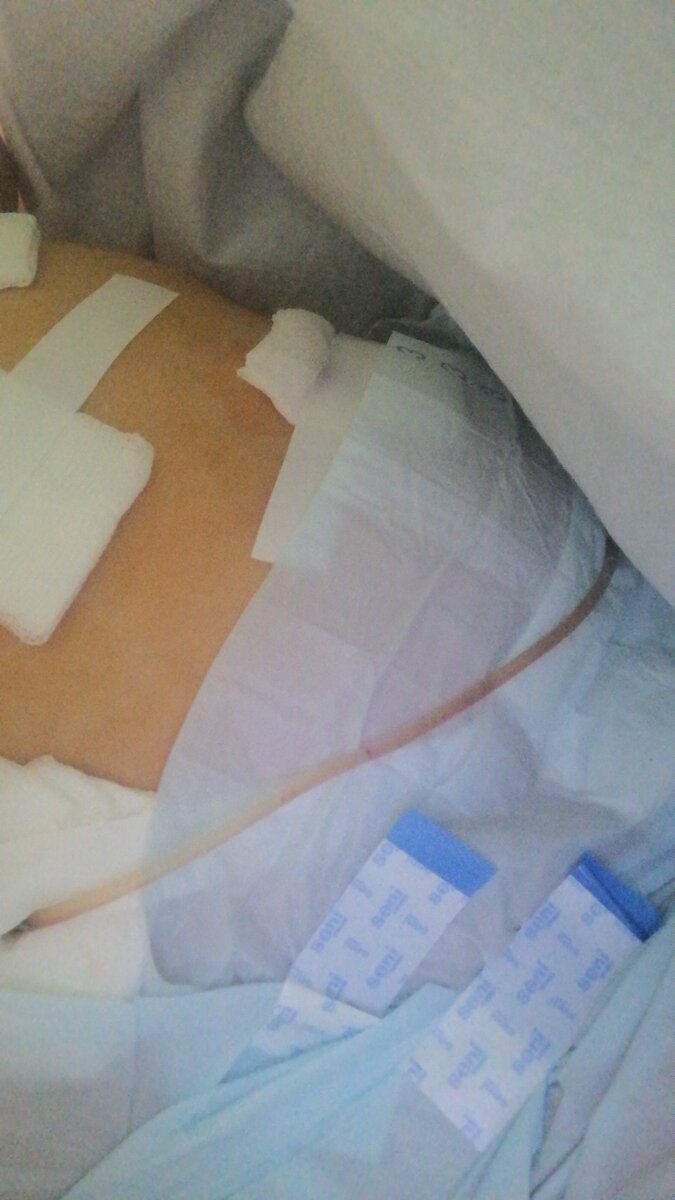 Мне удалили желчный пузырь | Жизнь без обработки | Дзен