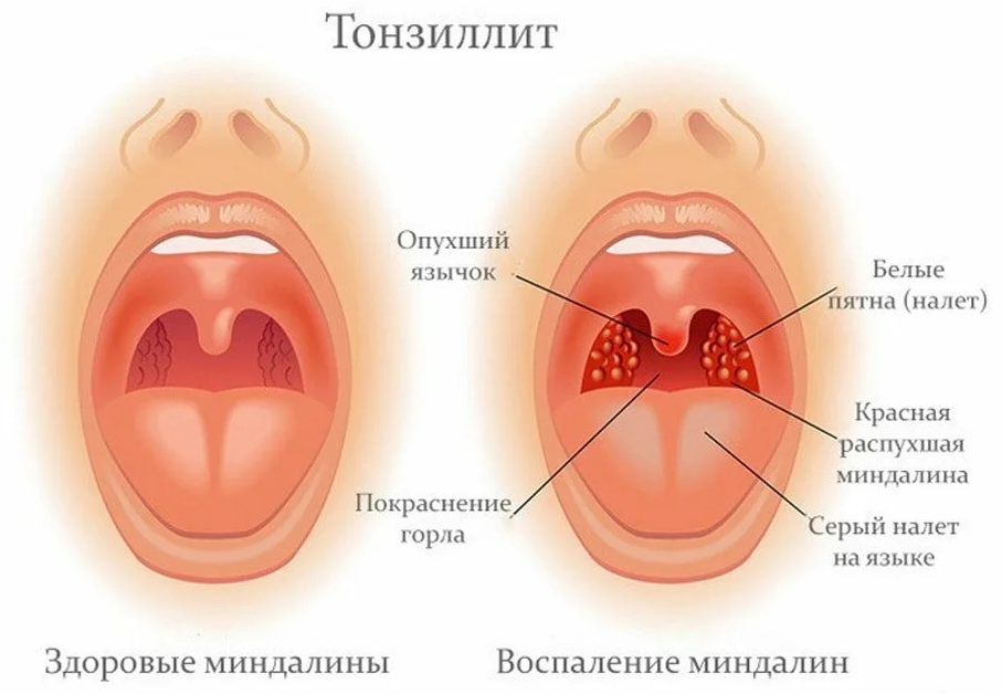 Источник: https://fnkc-fmba.ru/zabolevaniya/tonzillit/