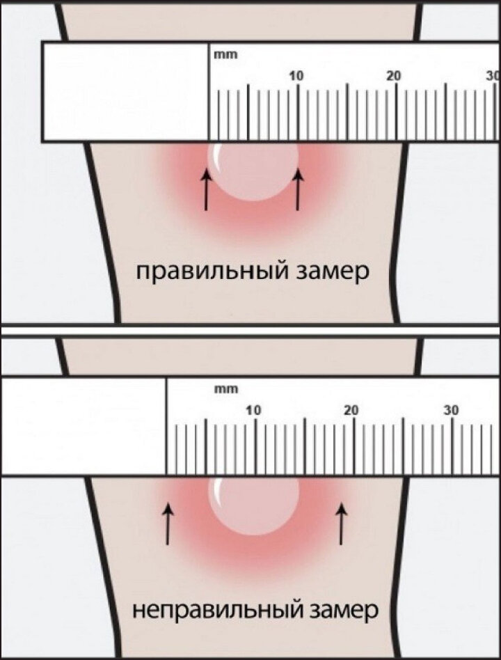 Размер манту норма в 5