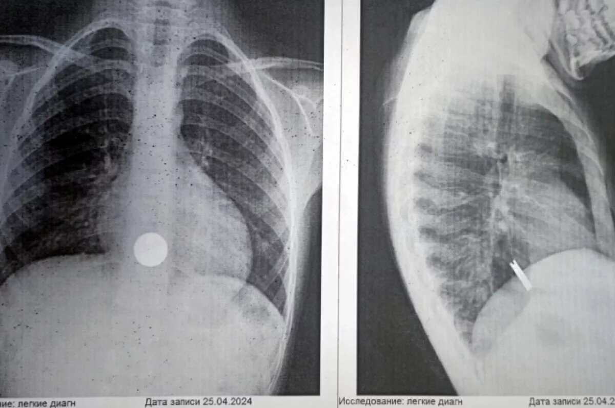 В Барнауле врачи спасли ребенка, который проглотил монеты | АиФ–Барнаул |  Дзен