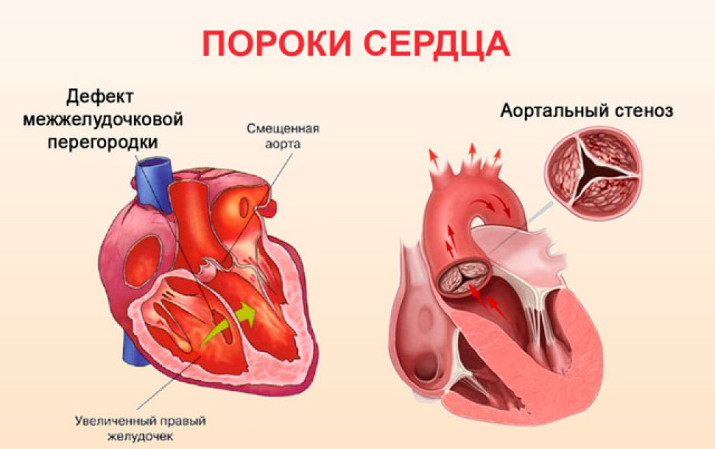 Порок сердца проявления