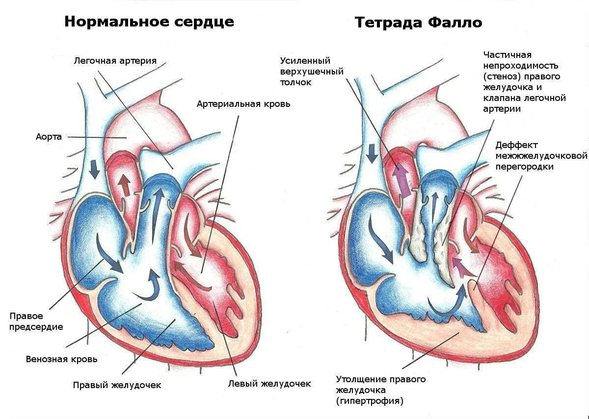 Пороки сердца названия. Тетрада Фалло это врожденный порок сердца. Врожденные пороки сердца схема. ВПС Тетрада Фалло у детей. Врожденные пороки сердца болезнь Фалло.