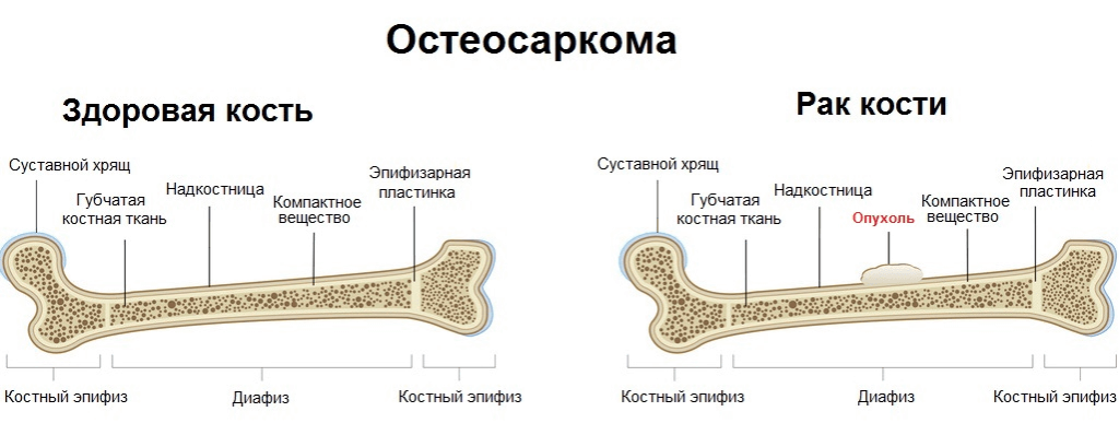 Рак костей анализы