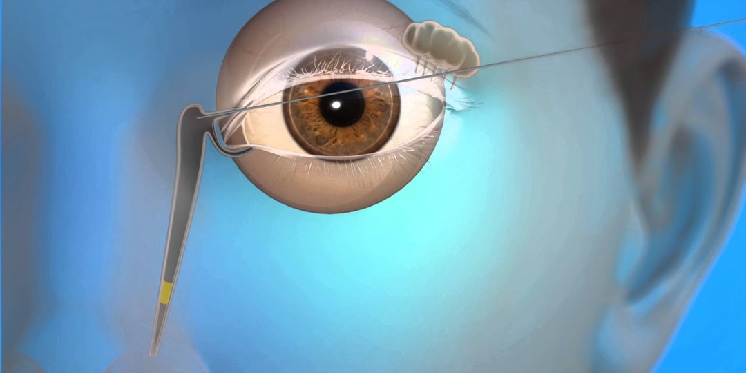 Проблемы со слезными железами – сухость глаз, дакриоцистит и не только: что делать?