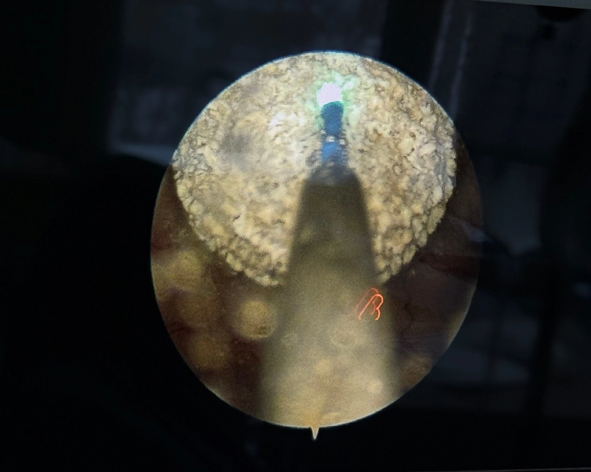 Плотный камень в мочеточнике