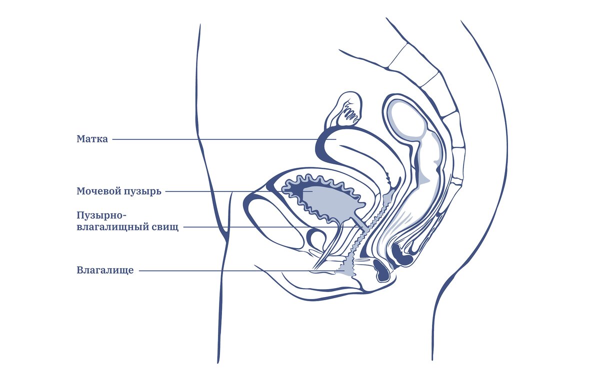 Пузырно-влагалищный свищ