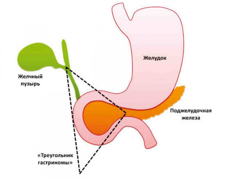 около 80% гастрином локализуются в анатомической области, известной как «треугольник гастриномы»