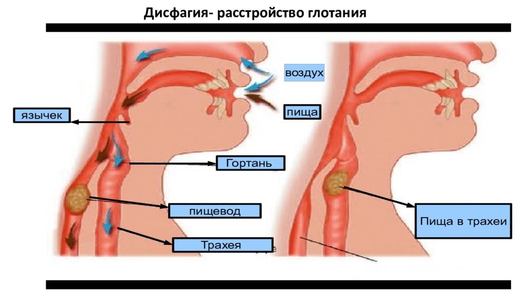 Больно глотать в пищеводе. Расстройство глотания. Глоточно-пищеводная дисфагия.