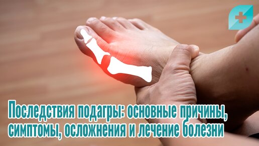 Последствия подагры: основные причины и симптомы, осложнения и лечение болезни