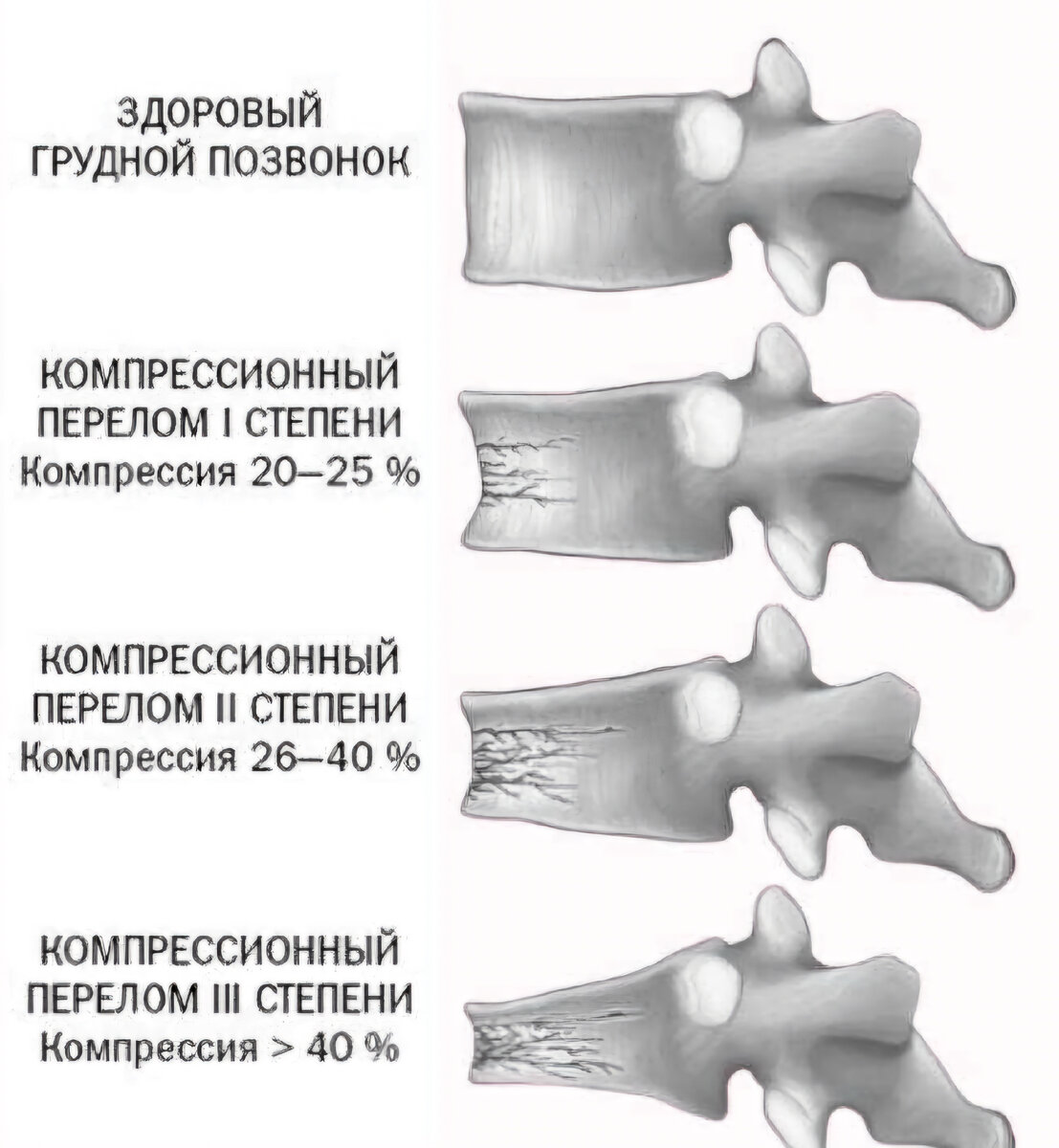 Компрессионный перелом позвоночника: причины, симптомы, диагностика, лечение