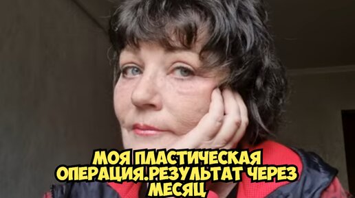 Моя пластическая операция в Корее . Результат через месяц . Докфайндер Корея и View Plastic Surgery