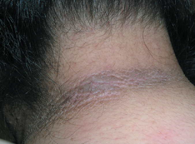 Черный акантоз на коже шеи