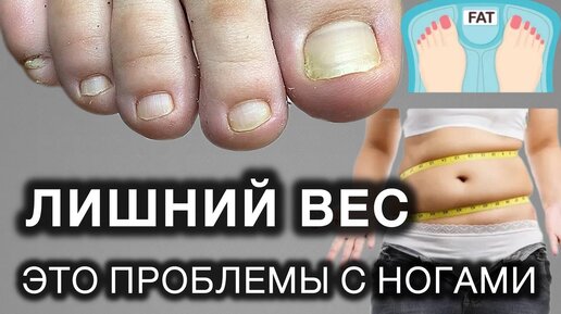 ОНА ПОТОЛСТЕЛА И ИСПОРТИЛА НОГТИ НА НОГАХ #подолог #подология #вросшийноготь #обучениеподологии