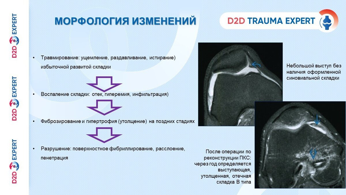 Операция при синдроме медиопателлярной складки коленного сустава: как проходит, сроки реабилитации