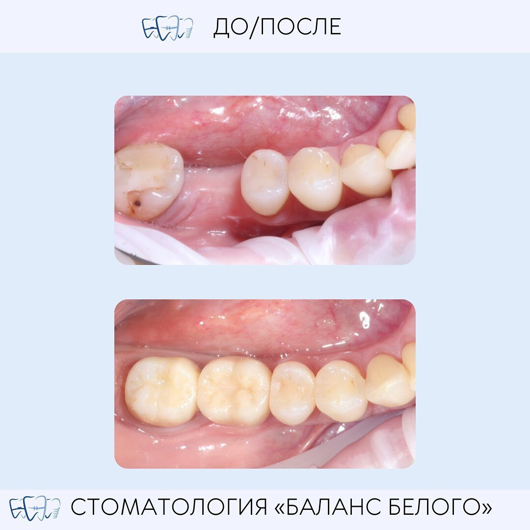 Классическая имплантация зубов в Москве