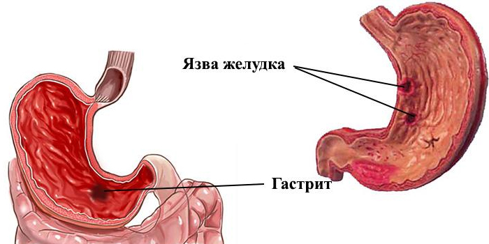 Что находится внутри язвы Откуда берутся язва желудка и гастрит - плохое питание, стрессы или это бактерии