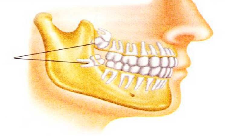 Что такое и как выглядят зубы мудрости? Нужно ли вам удалять зубы мудрости?
