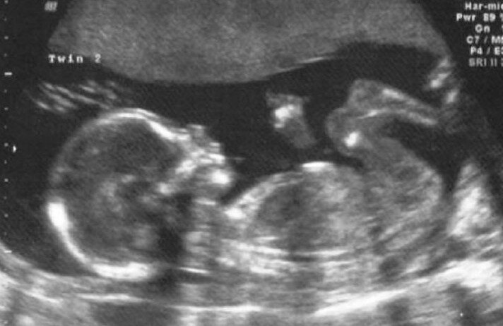 Ребёночку 18 недель. фото из инета.