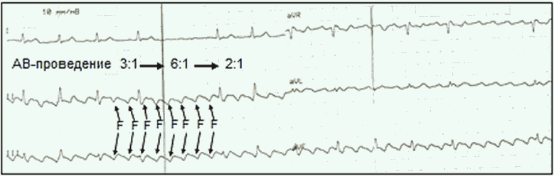 Вот так выглядит "пила" трепетания предсердий на ЭКГ. Каждый зуб пилы - это активация (и сокращение) предсердий. Видно, что на желудочки проведение нерегулярное, и интервалы между сокращениями (активациями) желудочков скачкообразно изменяются.