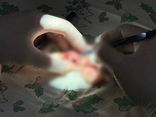 После операции он может дышать через нос, есть и пить. Теперь мальчику предстоит пластика лица