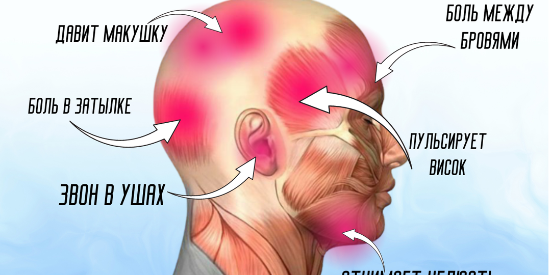О чем говорит боль в разных частях головы: от мигрени до воспаления нерва