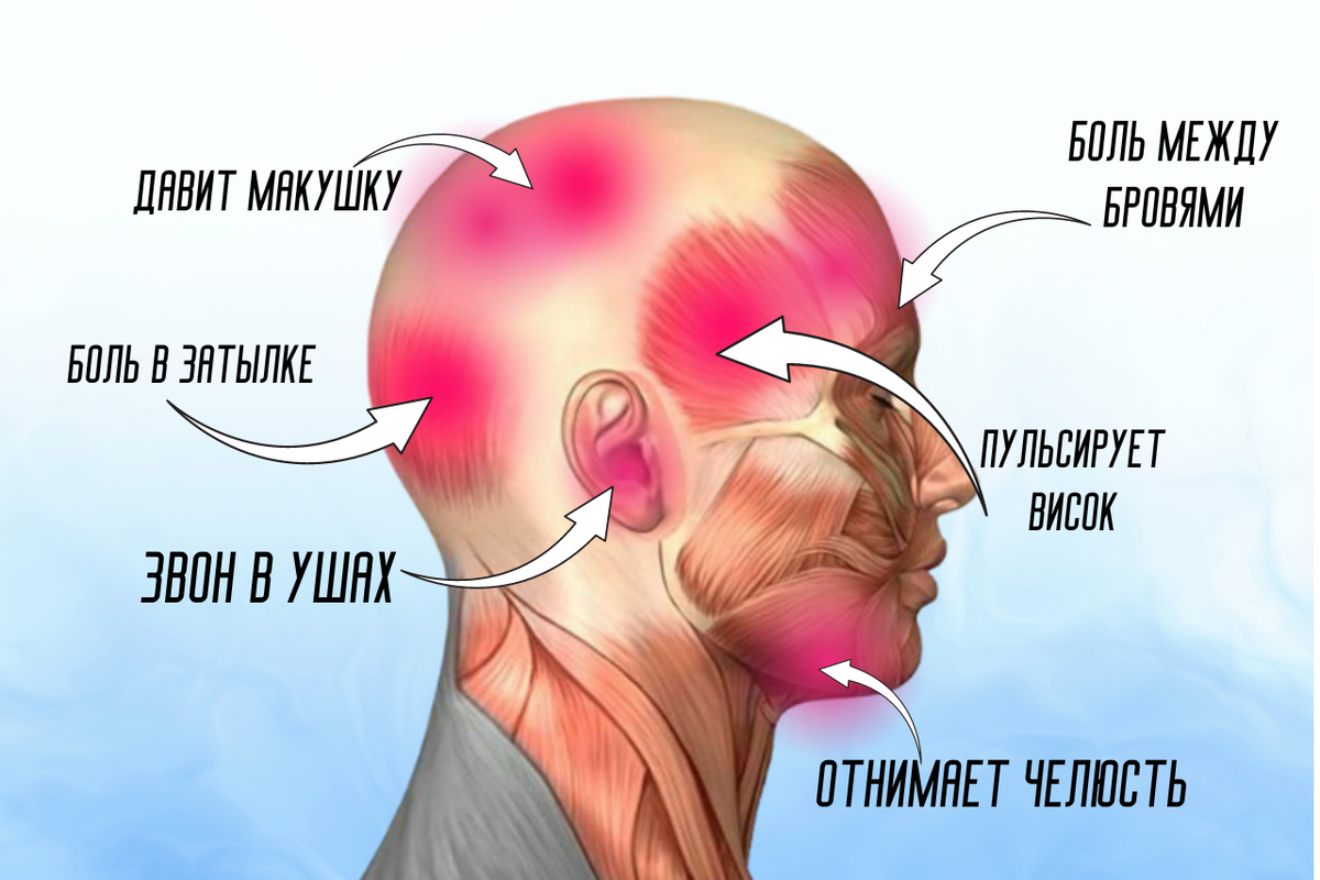 О чем говорит боль в разных частях головы: от мигрени до воспаления нерва