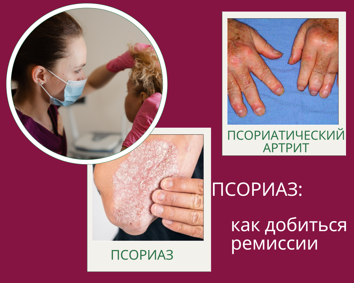 Псориаз. Случай из практики | Клиника Эхинацея | Дзен