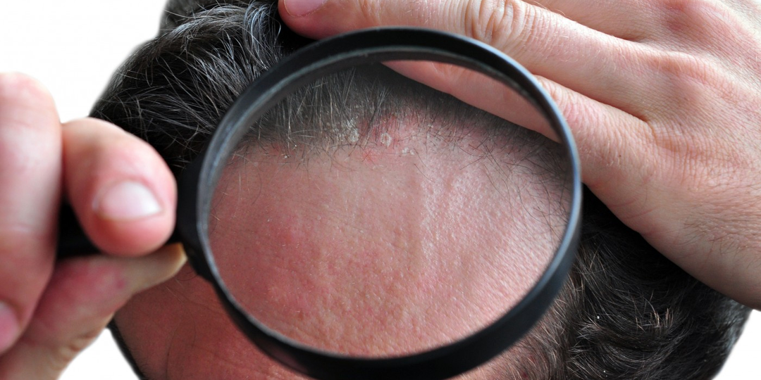 Если псориаз поражает кожу головы – как устранить бляшки и зуд? Советы специалистов