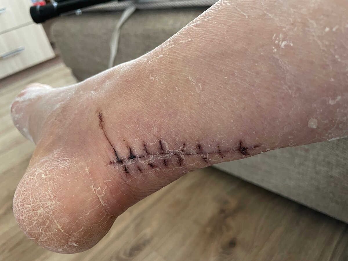 Фото шва сделала сразу, как сняли гипс. 