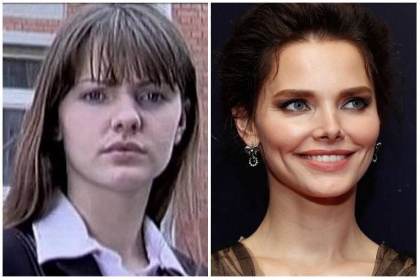Елизавета Боярская до и после пластики носа