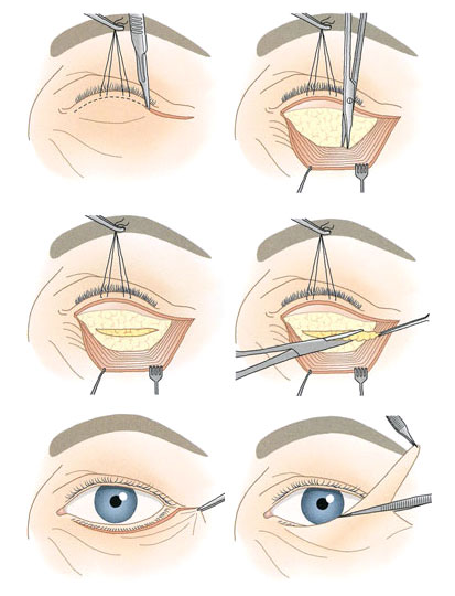 Классическая нижняя блефаропластика с подресничным доступом