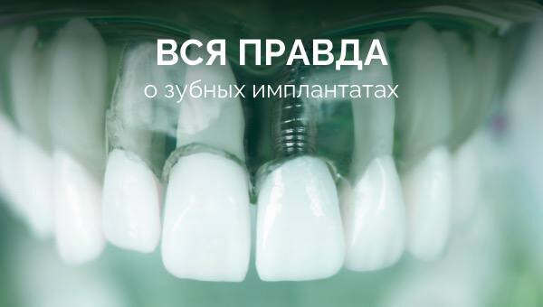 Зубной имплантат — Википедия