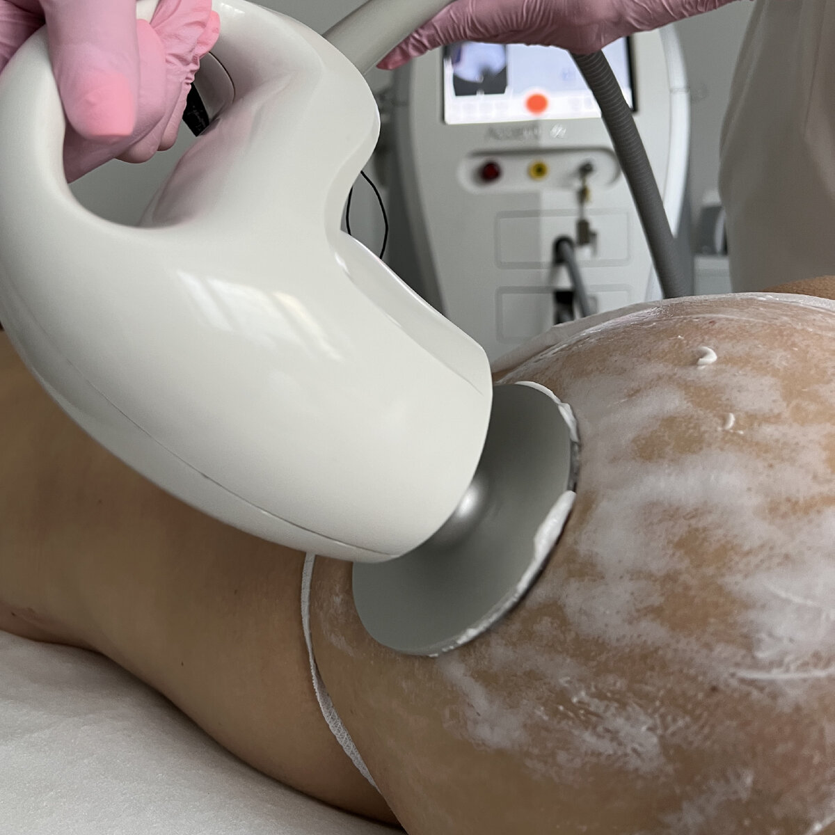 Ультразвуковой липолиз - программа Body Up на аппарате Accent в клинике косметологии GEN87