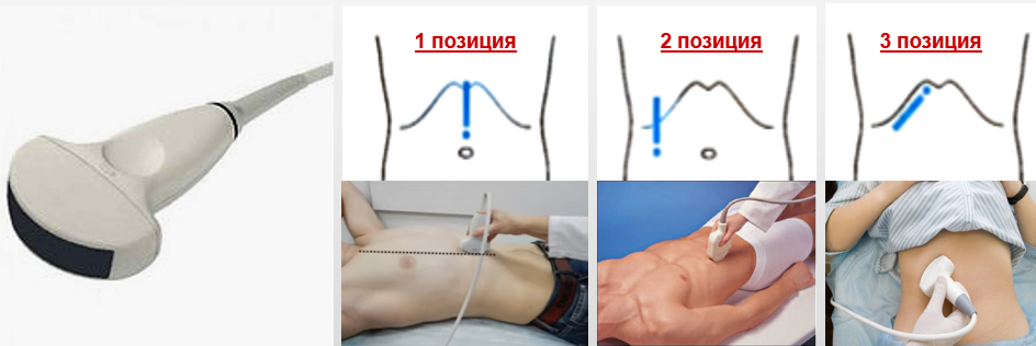 Положение пациента – на спине. При необходимости – на боку.  Датчик – конвексный частотой 2,5-5,0 МГц (средняя частота 3,5-3,75 МГц).-2