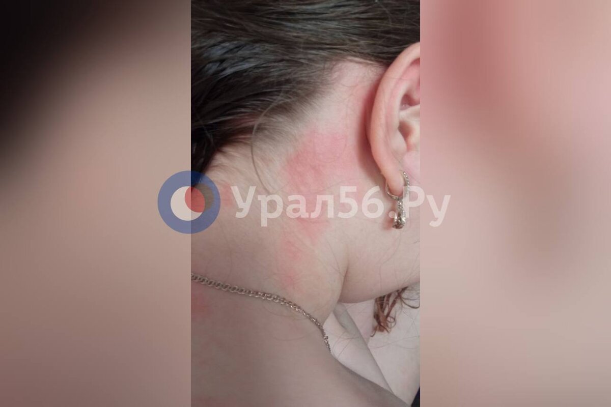    «У нее прям в душе все тело стало покрываться пятнами»: у жителей Орска аллергия на хлорированную воду?
