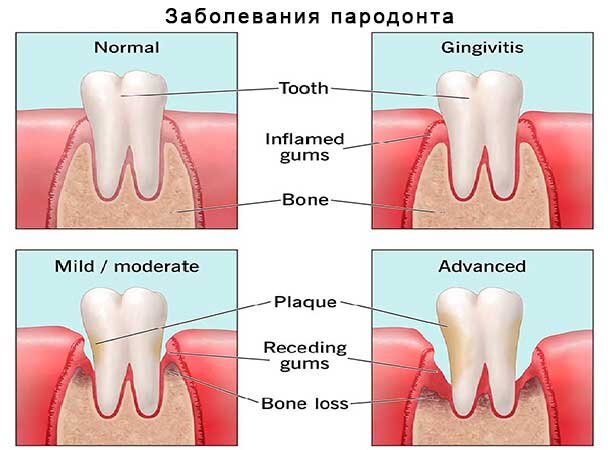 Экзостоз челюсти: методы удаления остеофитов, симптомы экзостоза десны — ROOTT