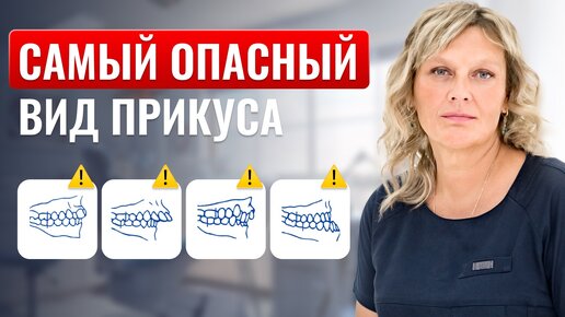 Виды прикусов. Как определить, есть ли у вас проблемы с прикусом?