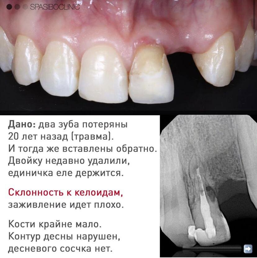 Передние зубы потеряны больше 20 лет назад - травма. Девушка принесла их врачу, вставили, и все это время зубы стояли. Но срок их жизни подошел к концу. Двойка уже удалена, еденичка еле держится.-2