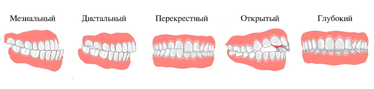 Виды прикуса