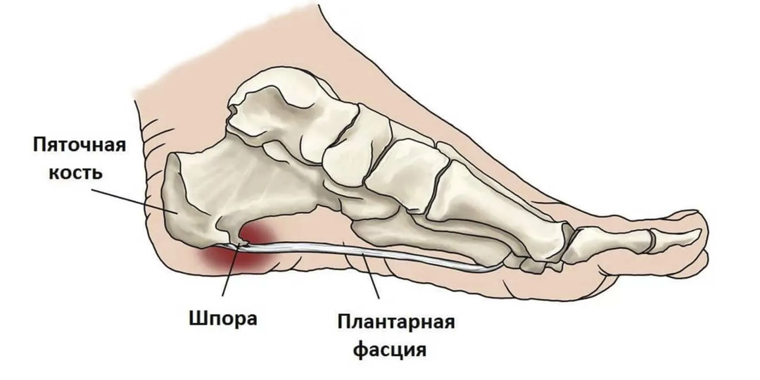 Резкая, сильная боль в пятке, будто гвоздь забили – что такое пяточная шпора и как ее лечить?