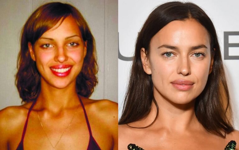 Шейк до и после операции Irina Shayk. Nose tip sharpened Plastic surgery, Celebrity plastic surgery, Rhin